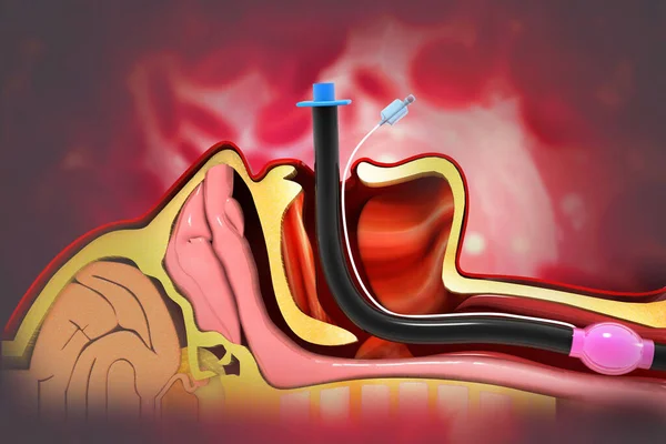 Bases teóricas de la intubación endotraquea